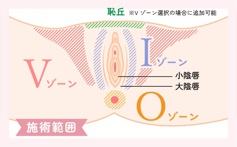 ローマピンクの施術範囲図解