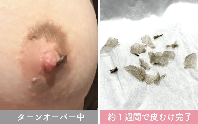バストトップ（乳首）の症例写真1