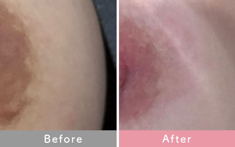 バストトップ（乳首）の症例写真2