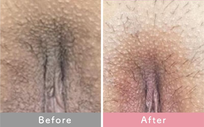 デリケートゾーン（VIO）の症例写真